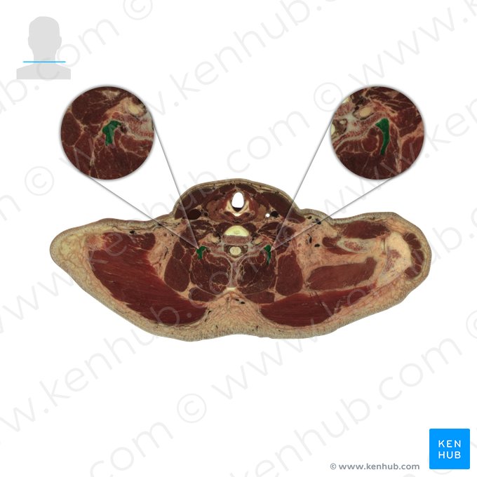 Longissimus capitis muscle (Musculus longissimus capitis); Image: National Library of Medicine