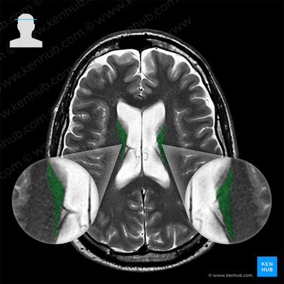 Corpus nuclei caudati (Körper des Schweifkerns); Bild: 