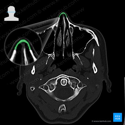 Hueso nasal (Os nasale); Imagen: 