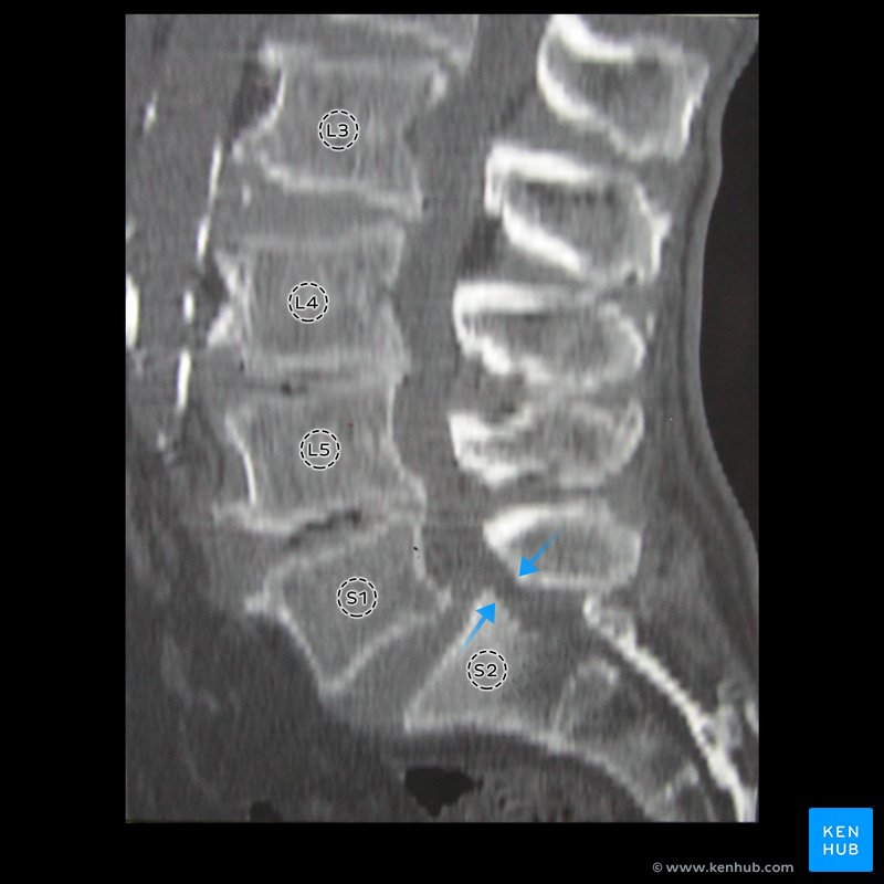 S1 lumbarization and sacrolisthesis - sagittal view