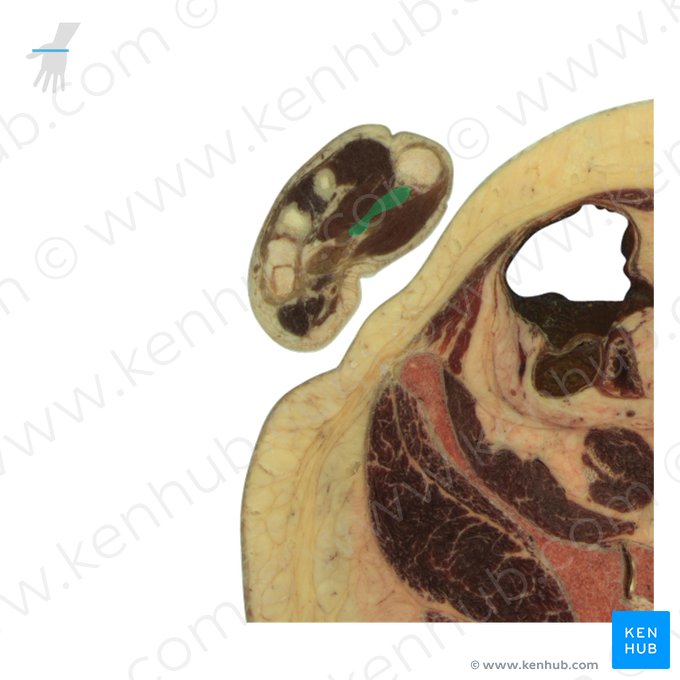 Caput obliquum musculi adductoris pollicis (Schrägverlaufender Kopf des Daumenanziehers); Bild: National Library of Medicine