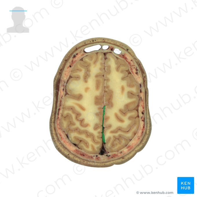 Falx cerebri (Hirnsichel); Bild: National Library of Medicine