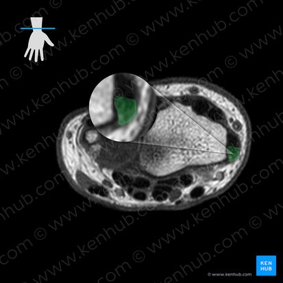 Tendon of abductor pollicis longus muscle (Tendo musculi abductoris pollicis longi); Image: 