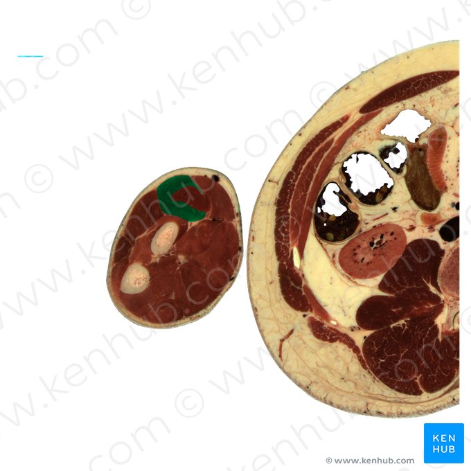 Musculus extensor carpi radialis brevis (Kurzer speichenseitiger Handstrecker); Bild: National Library of Medicine