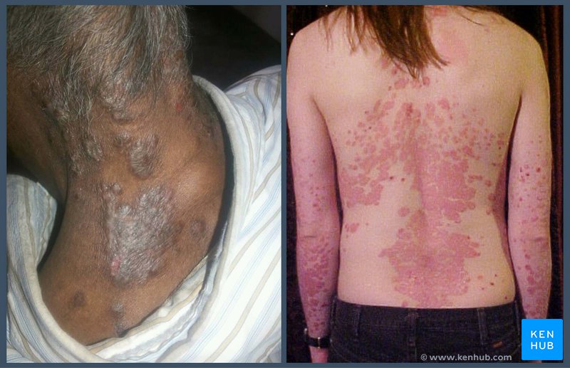 Presentation of psoriasis on dark skin vs white skin