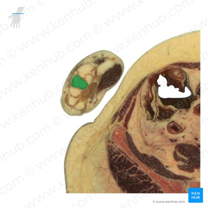 Capitate bone (Os capitatum); Image: National Library of Medicine