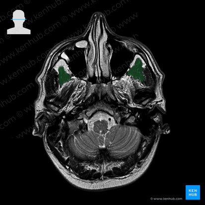Temporalis muscle (Musculus temporalis); Image: 