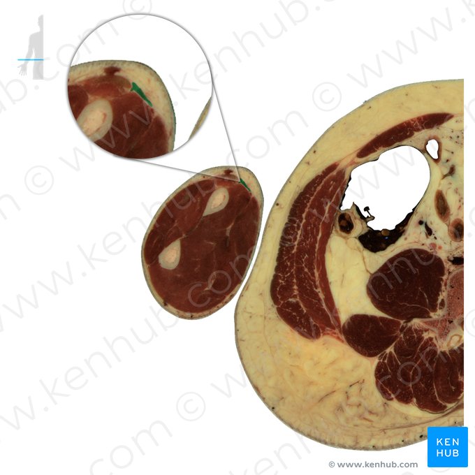 Musculus brachioradialis (Oberarm-Speichen-Muskel); Bild: National Library of Medicine