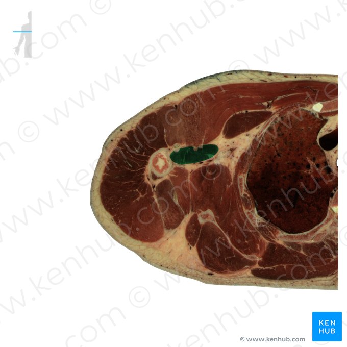 Músculo coracobraquial (Musculus coracobrachialis); Imagem: National Library of Medicine