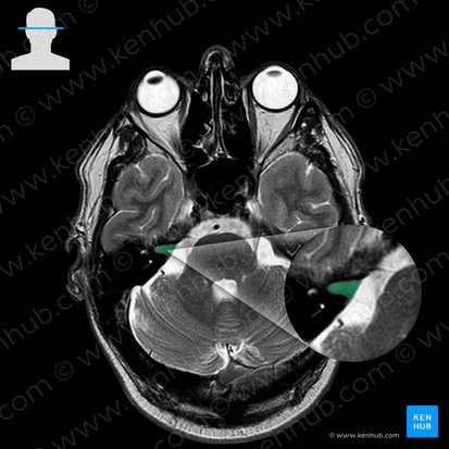 Internal acoustic meatus (Meatus acusticus internus); Image: 