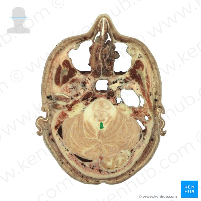 Lingula cerebelli (Lingula des Kleinhirns); Bild: National Library of Medicine