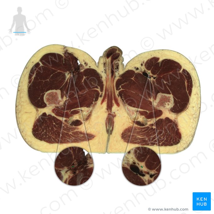 Nervo femoral (Nervus femoralis); Imagem: National Library of Medicine