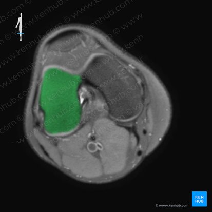 Cóndilo lateral del fémur (Condylus lateralis femoris); Imagen: 
