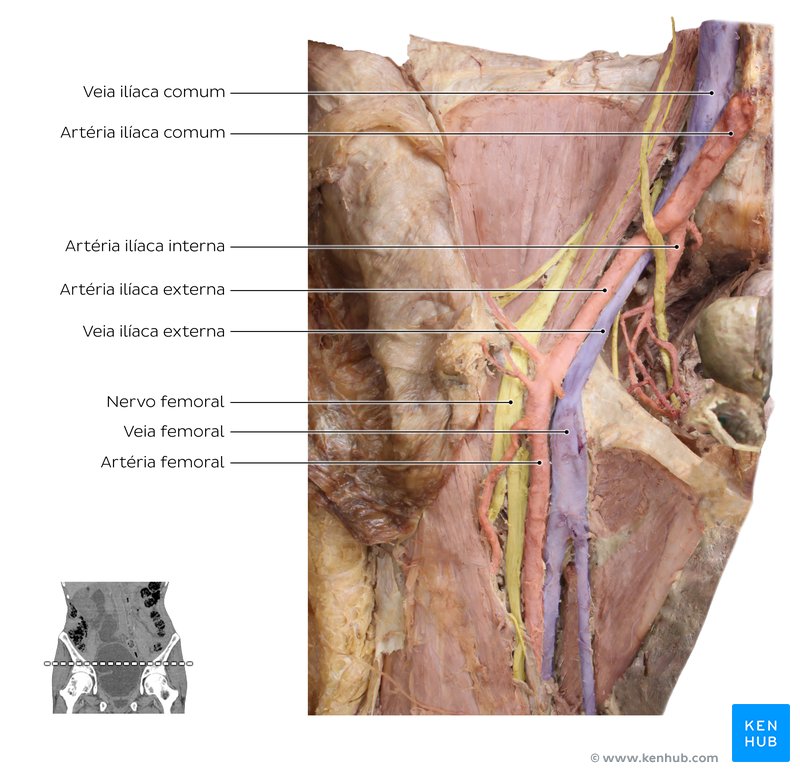 Dissecção cadavérica dos vasos ilíacos: Os vasos ilíacos comuns podem ajudá-lo a identificar o nervo obturatório. Com seu dedo na fáscia extraperitoneal no lado medial do psoas maior, crie um espaço entre o músculo e os vasos ilíacos comuns. O nervo obturatório estará localizado ali. With your finger in the extraperitoneal fascia on the medial side of psoas major, create a gap between the muscle and the common iliac vessels. The obturator nerve will be located here.