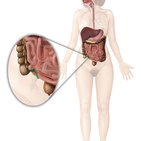 Clinical case: Subhepatic cecum with subhepatic appendicitis