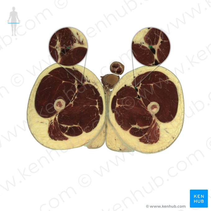 Artéria femoral (Arteria femoralis); Imagem: National Library of Medicine