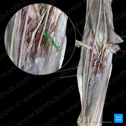 Ramos musculares do nervo mediano para o músculo flexor superficial dos dedos (Rami musculares nervi mediani cum musculus flexor digitorum superficialis); Imagem: 