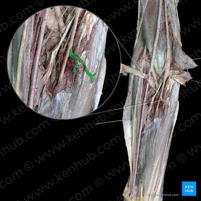 Rameaux musculaires du nerf médian pour le muscle fléchisseur superficiel des doigts (Rami musculares nervi mediani cum musculus flexor digitorum superficialis); Image : 