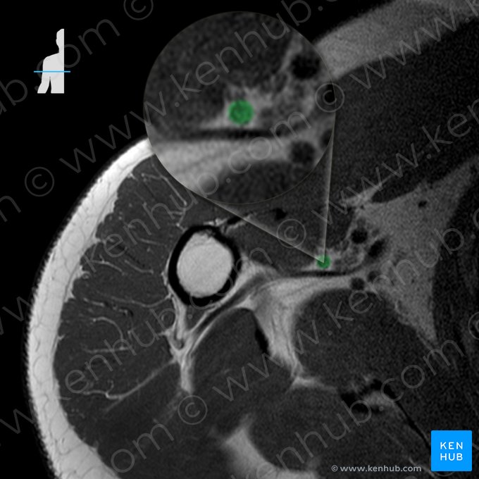 Arteria circumflexa anterior humeri (Vordere Oberarmkranzarterie); Bild: 