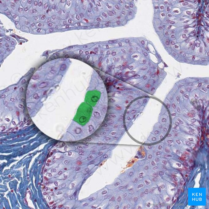 Células en paraguas (Urotheliocyti superficiales); Imagen: 