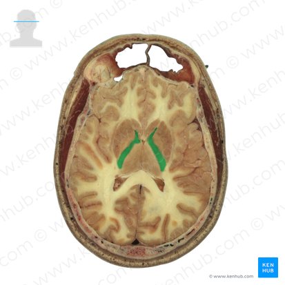 Capsula interna (Innere Kapsel); Bild: National Library of Medicine