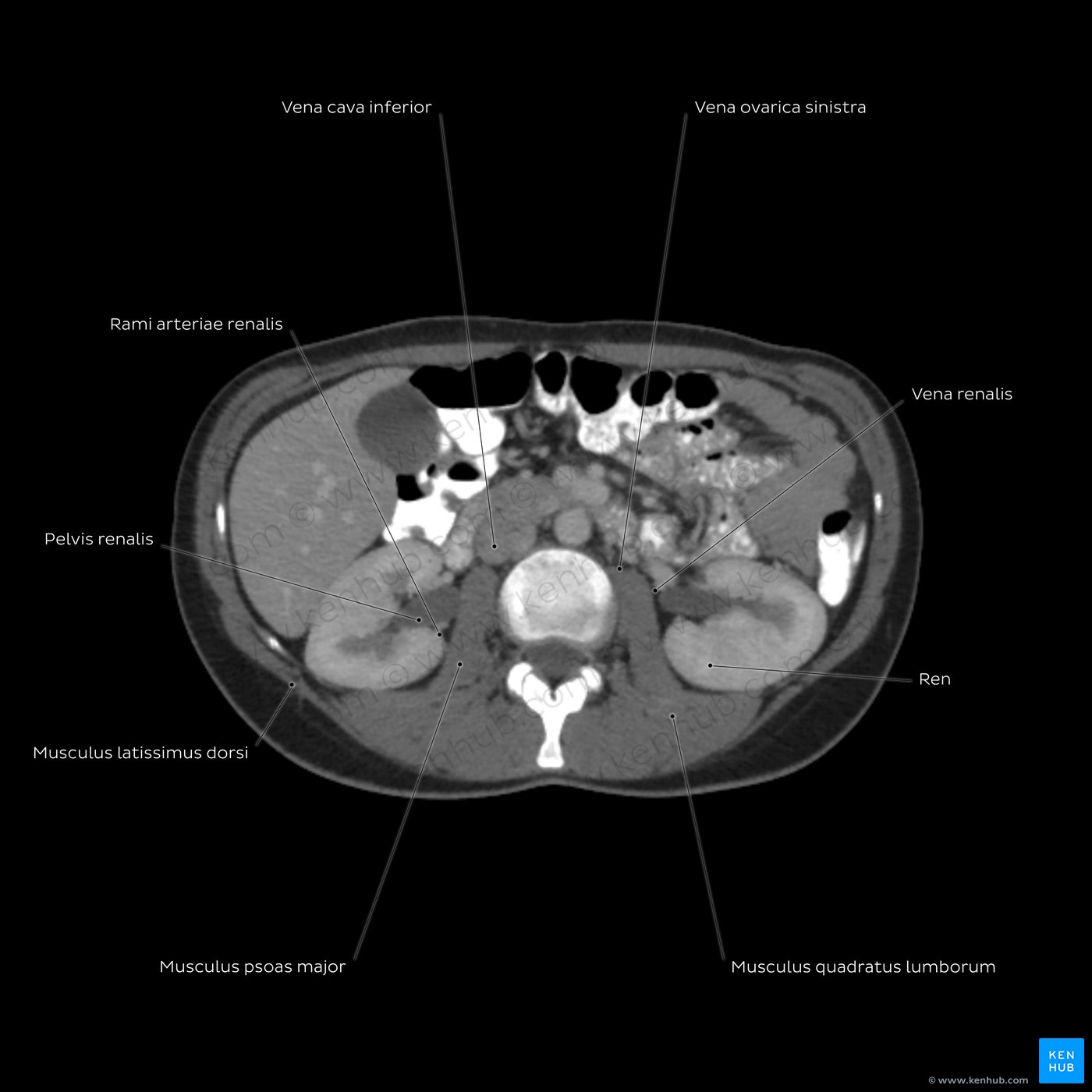 Abdominal CT overview: L3 level