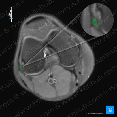 Ligamento colateral fibular de la articulación de la rodilla (Ligamentum collaterale fibulare genus); Imagen: 