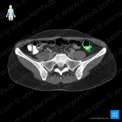 Descending colon (Colon descendens); Image: 