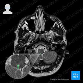 Orificio medio del cuarto ventrículo (Apertura mediana ventriculi quarti); Imagen: 