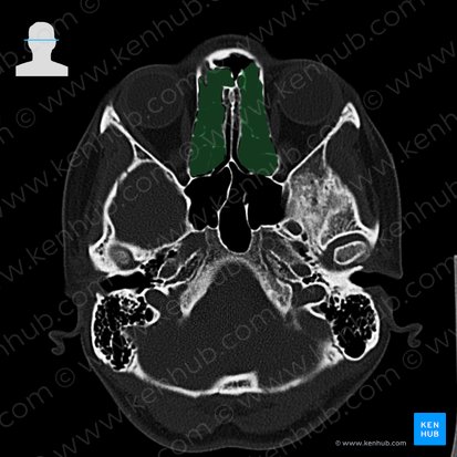 Ethmoidal cells (Cellulae ethmoidales); Image: 