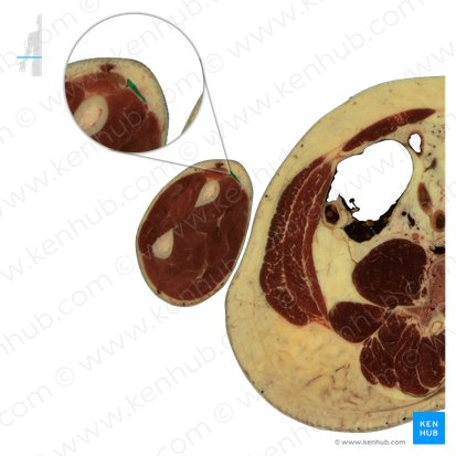 Brachioradialis muscle (Musculus brachioradialis); Image: National Library of Medicine