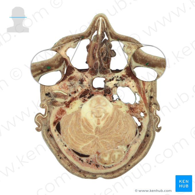 Facial vein (Vena facialis); Image: National Library of Medicine