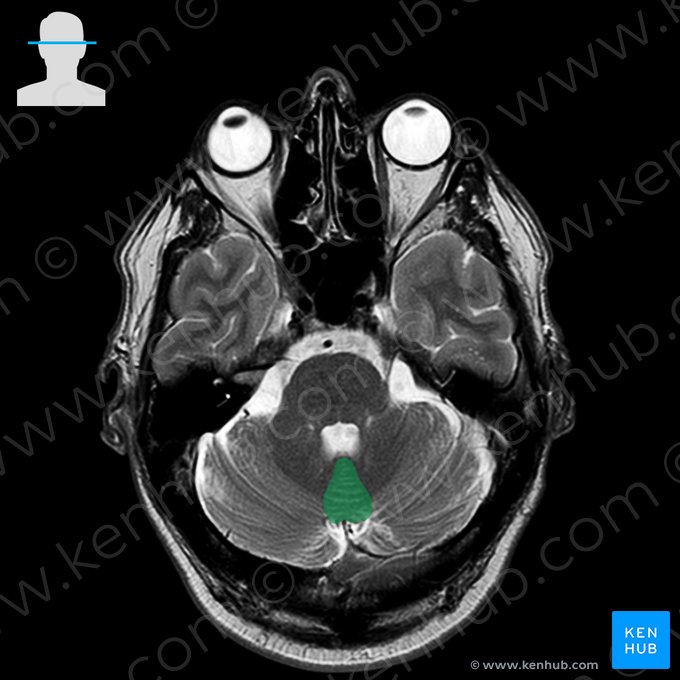 Vermis of cerebellum (Vermis cerebelli); Image: 