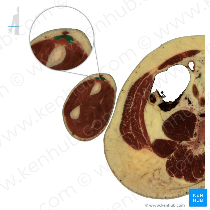 Músculo extensor radial longo do carpo (Musculus extensor carpi radialis longus); Imagem: National Library of Medicine