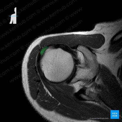 Tendón del músculo supraespinoso (Tendo musculi supraspinati); Imagen: 