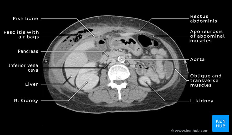 Abdominal fasciitis - axial CT