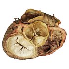 Clinical case: Long ectopic left main coronary artery
