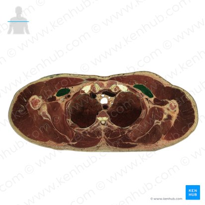 Pectoralis minor muscle (Musculus pectoralis minor); Image: National Library of Medicine