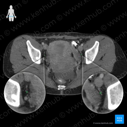 Obturator artery (Arteria obturatoria); Image: 