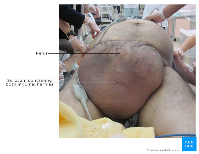 Inguinal hernia