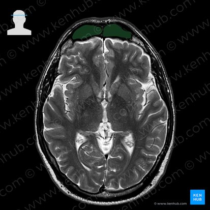 Seno frontal (Sinus frontalis); Imagen: 