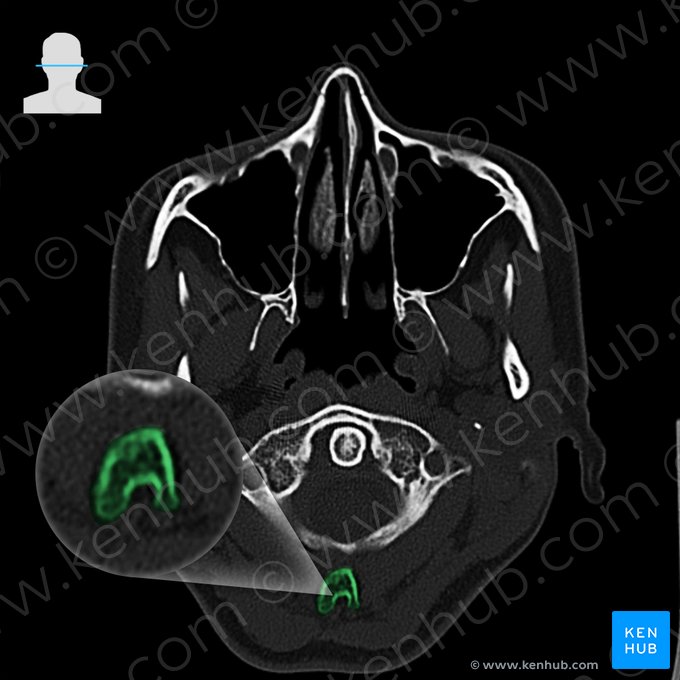 Processus spinosus axis (Dornfortsatz des Axis); Bild: 