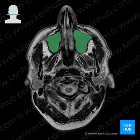 Maxillary sinus (Sinus maxillaris); Image: 