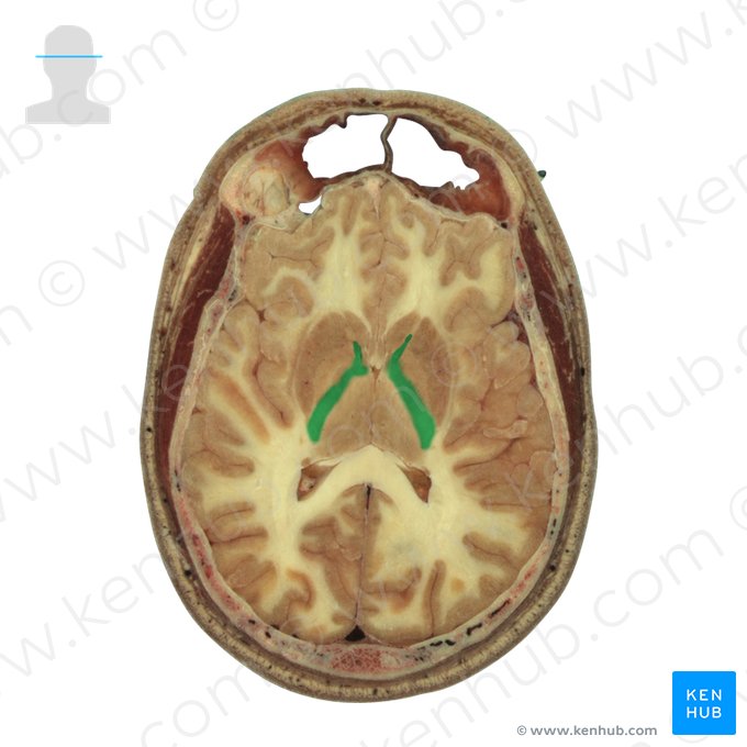 Cápsula interna (Capsula interna); Imagem: National Library of Medicine