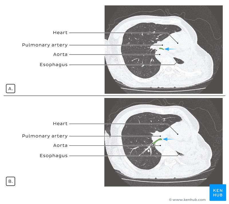 Result of gauze induced mediastinal realignment - axial CT