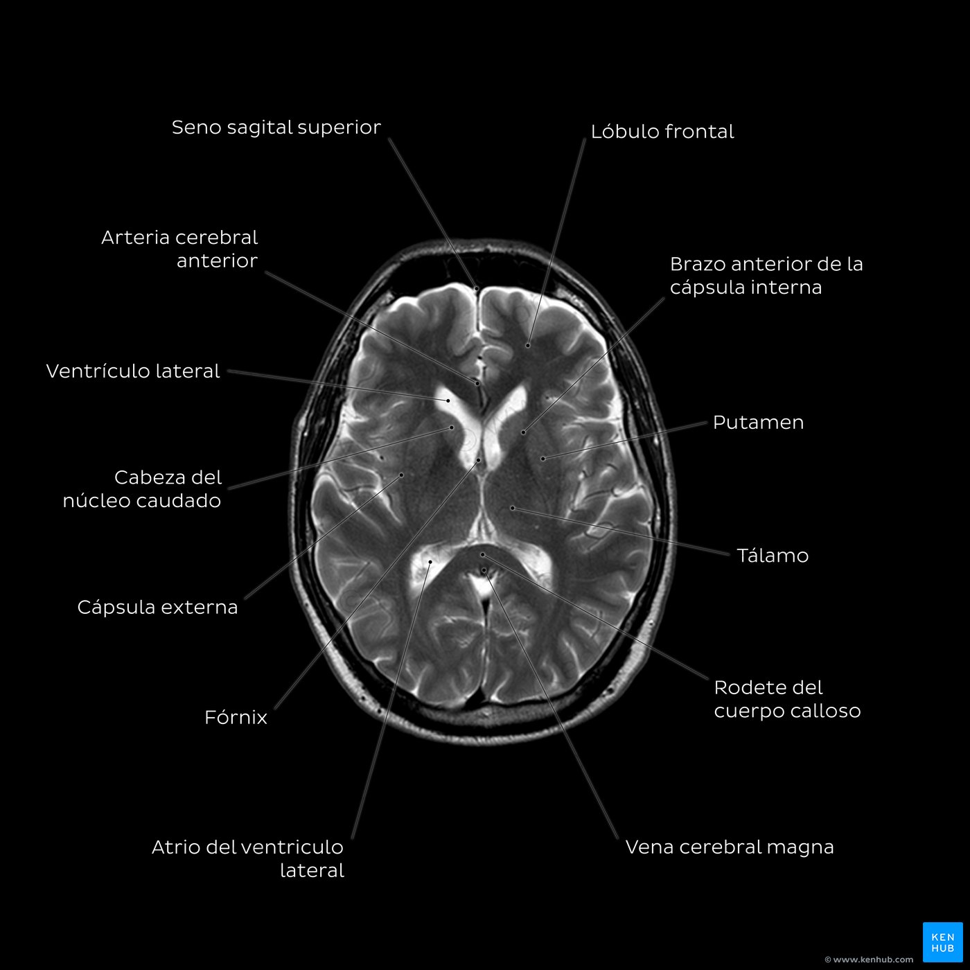 IRM cerebral (T2) - Nivel del tálamo