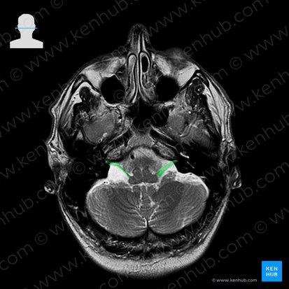 Nervio vestibulococlear (Nervus vestibulocochlearis); Imagen: 