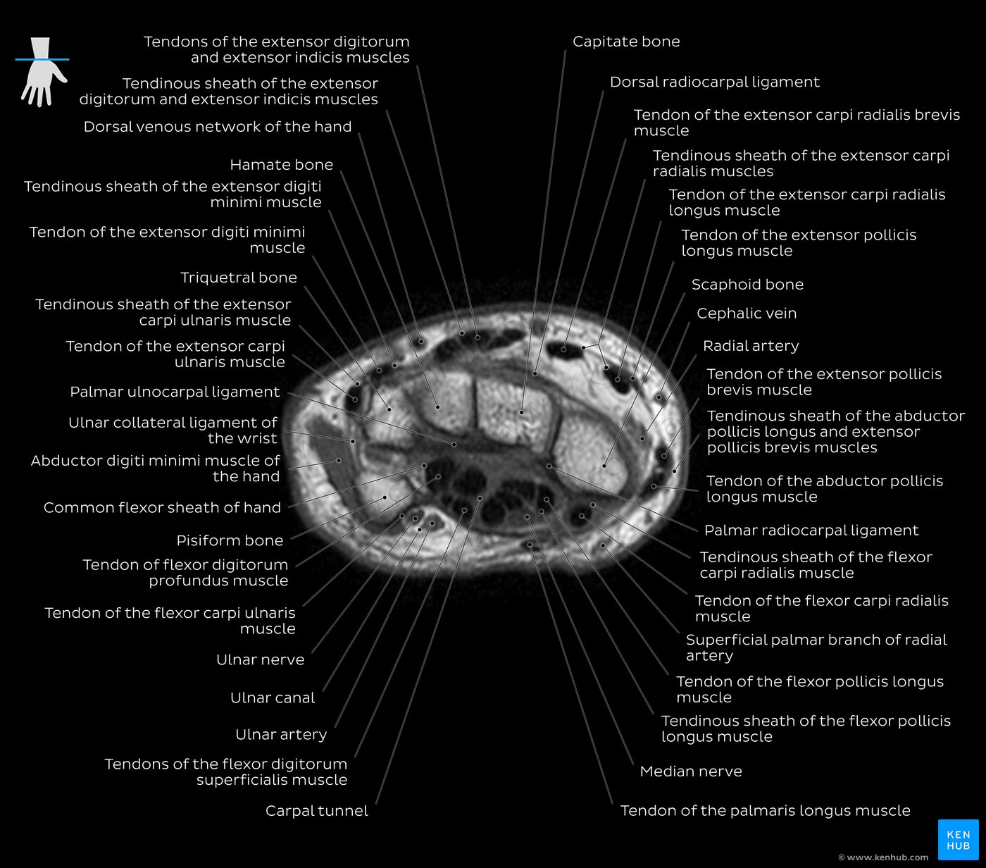 Wrist MRI T1w overview - Carpal tunnel