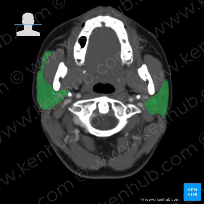 Parotid gland (Glandula parotidea); Image: 