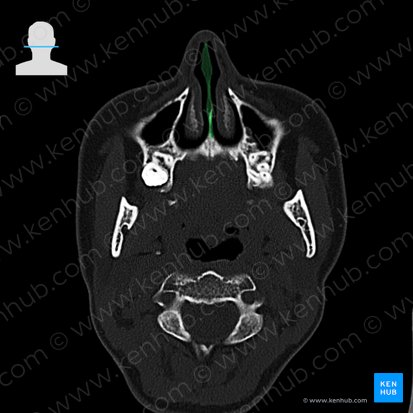 Nasal septum (Septum nasi); Image: 